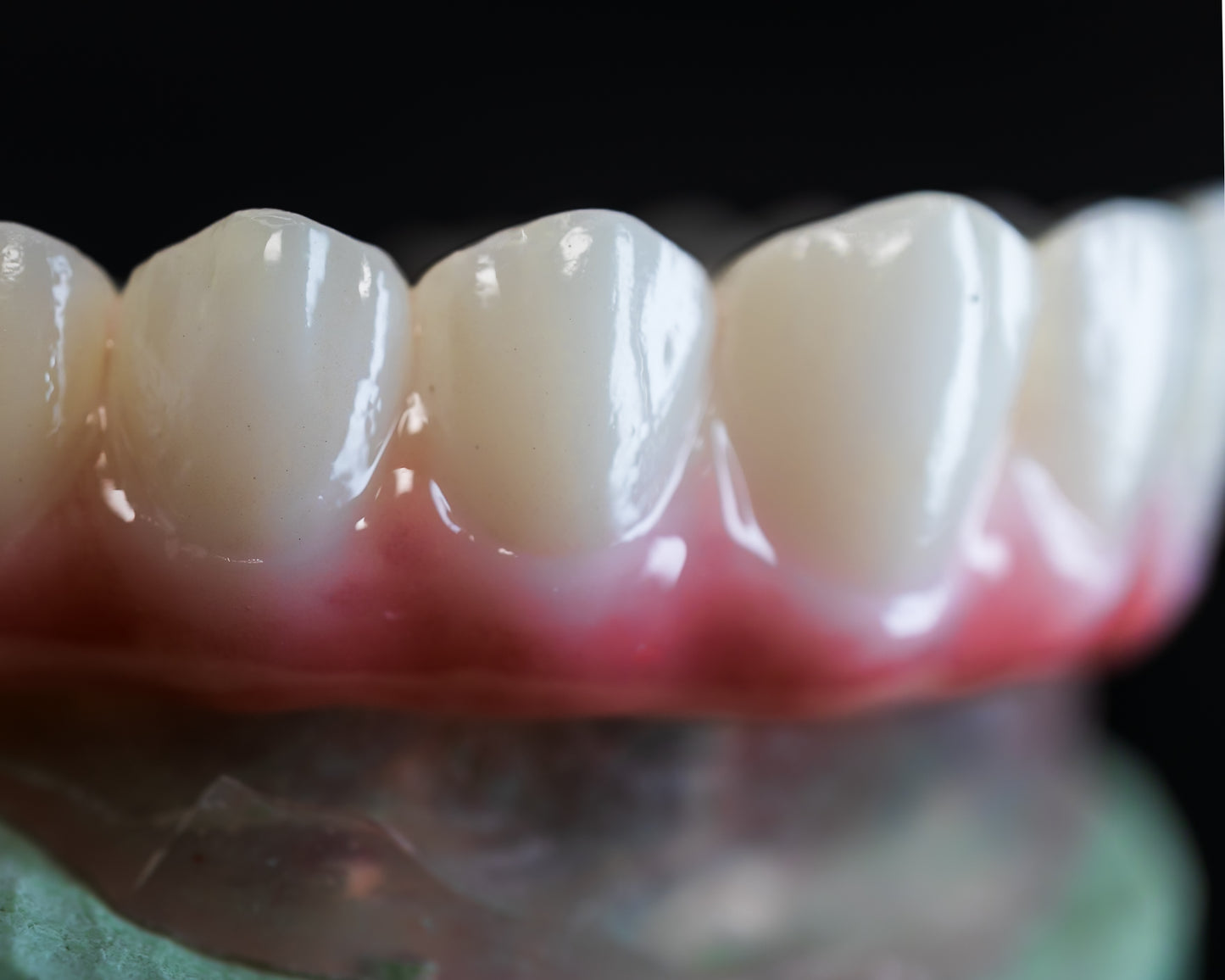 Full Arch Zirconia Hybrid (Additional charges apply)