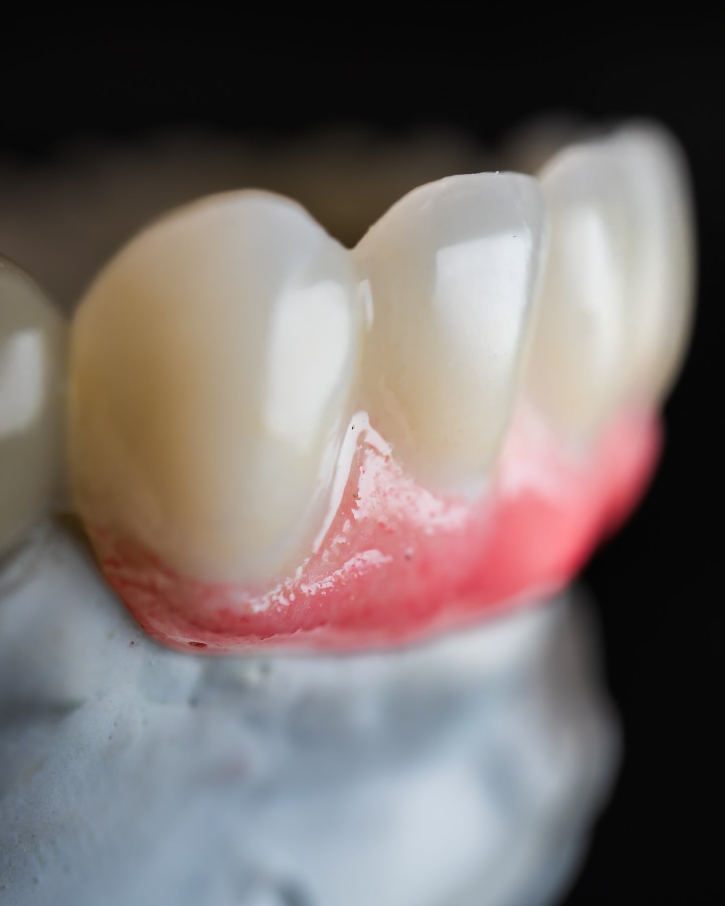 Full Arch Zirconia Hybrid (Additional charges apply)