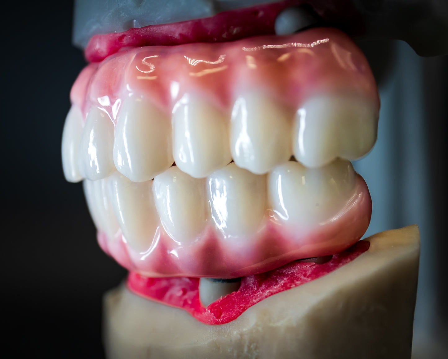 Full Arch Zirconia Hybrid (Additional charges apply)