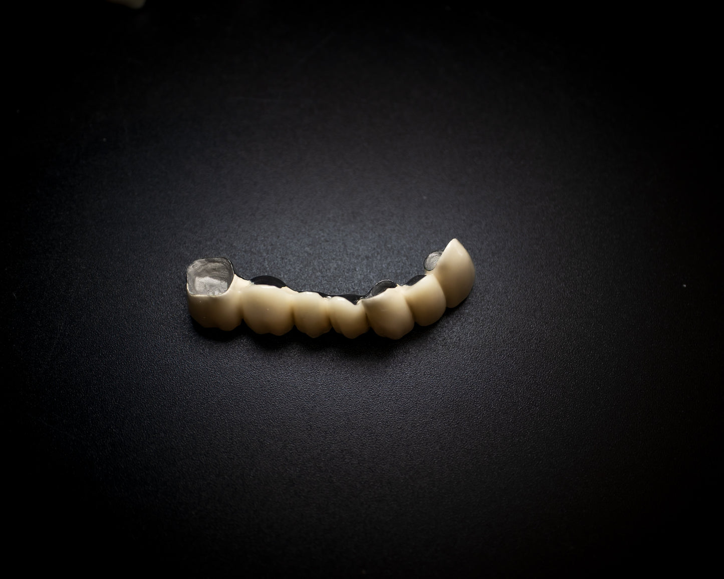 PFM Crown/Bridge (Additional charges apply)