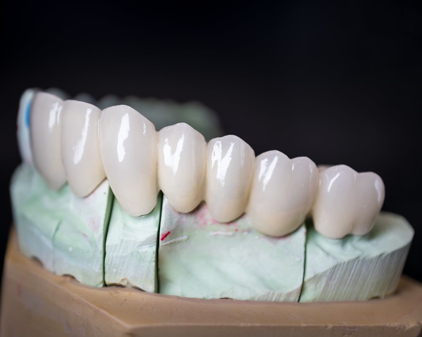 PFM Crown/Bridge (Additional charges apply)