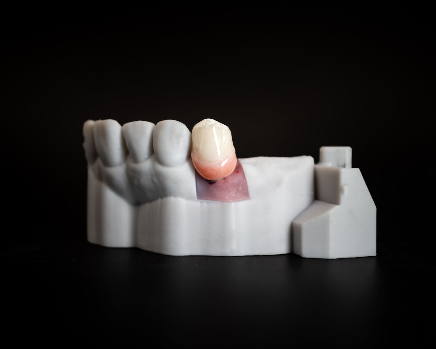 Screw/Cement-Retained Crown/Bridge (Additional charges apply)