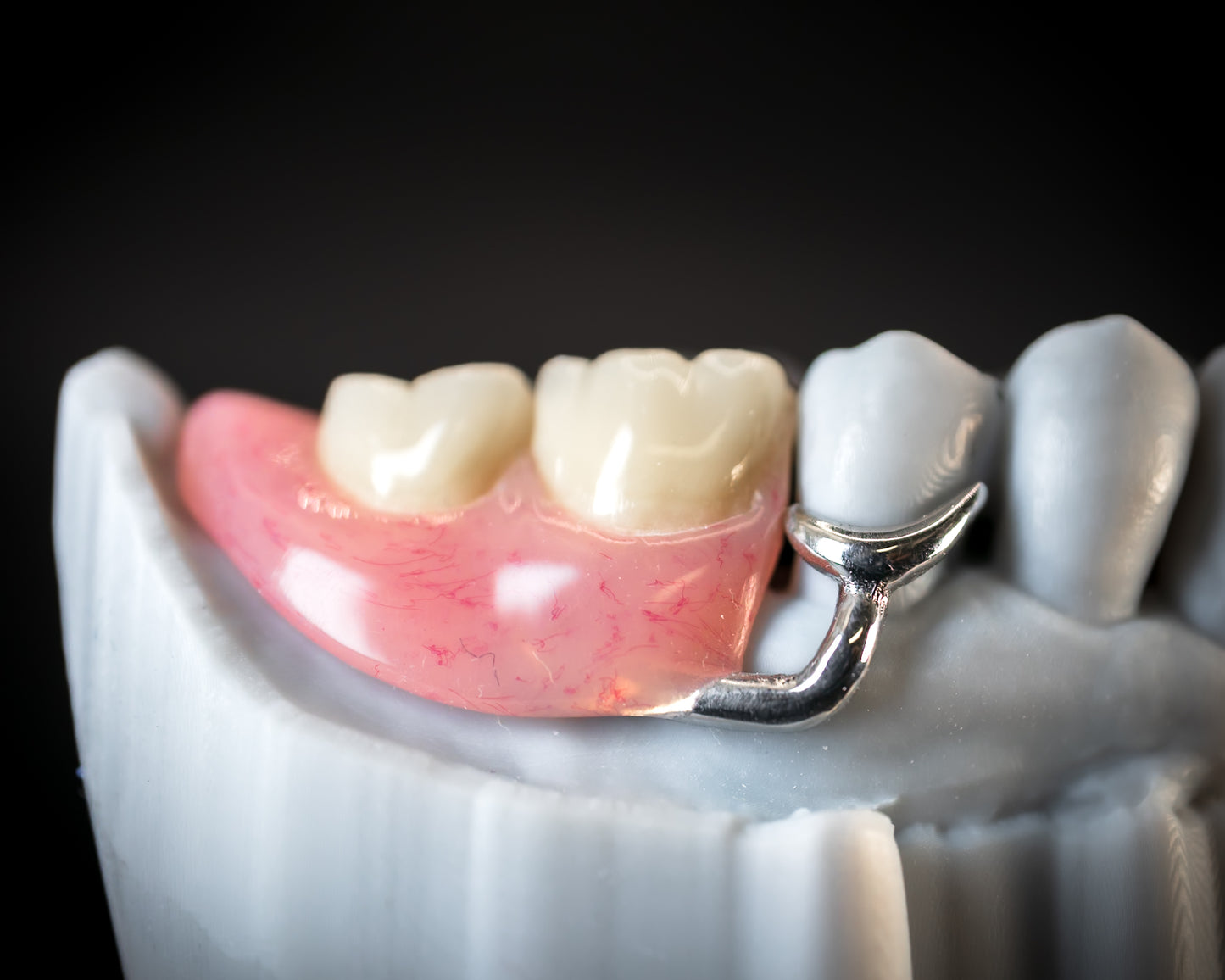 Metal Partials (CoCr) (Additional charges apply)