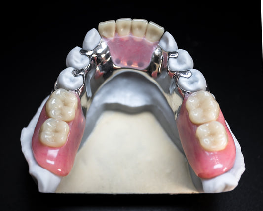 Metal Partials (CoCr) (Additional charges apply)
