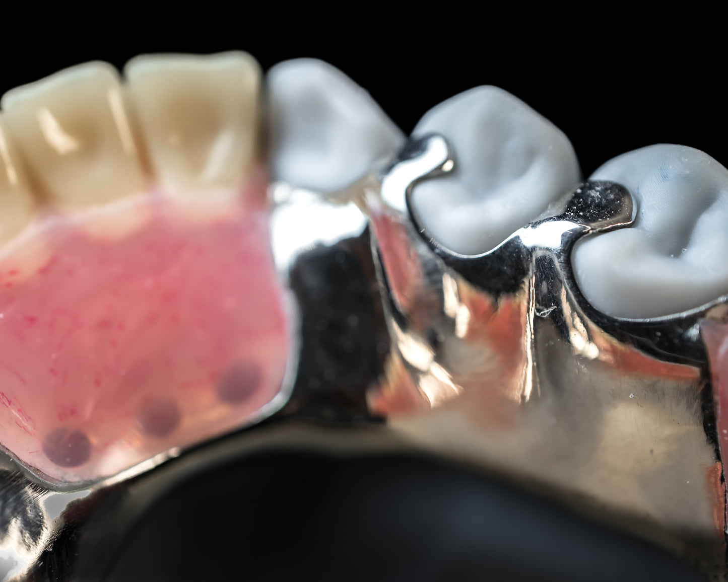 Metal Partials (CoCr) (Additional charges apply)