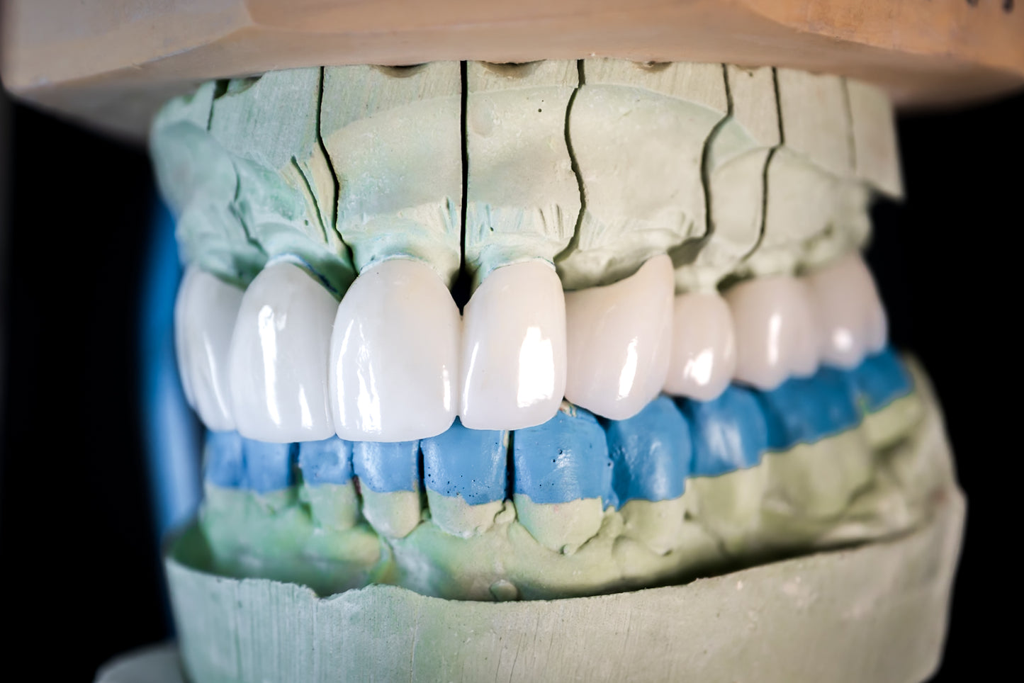 EMAX Crown (Additional charges apply)