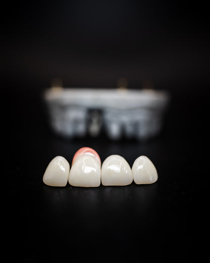 Custom Abutments (Additional charges apply)